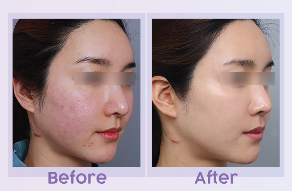 PRP before and after result 3